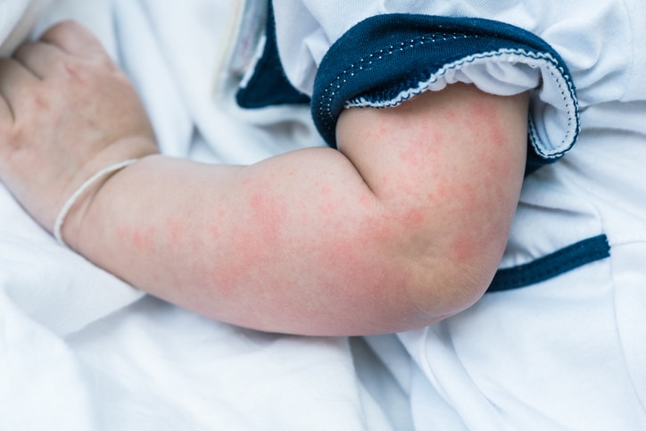 Close up image of baby skin texture suffering severe urticaria, nettle rash.