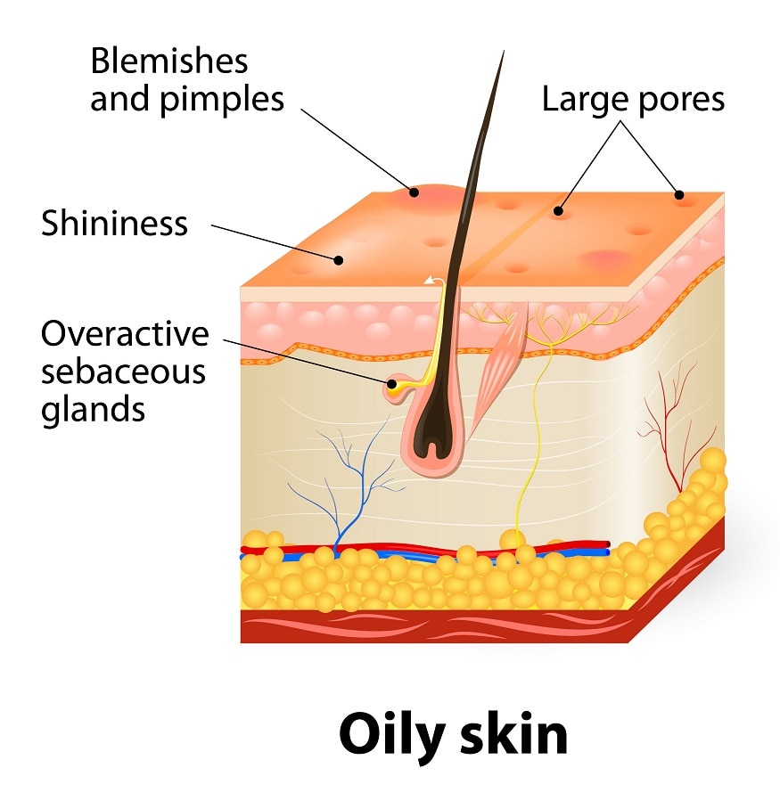 different-types-of-pores-learn-first-to-solve-large-pores-watsons