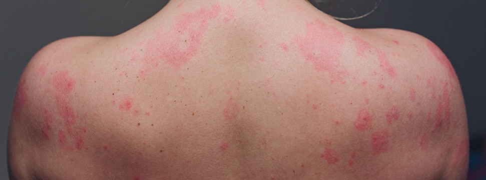 Prickly heat (heat rash)- Causes, home remedies and preventions