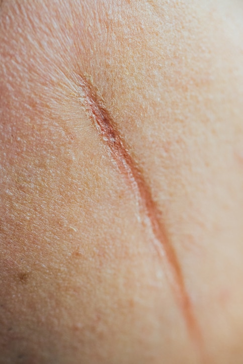 large scar on on face the cheek of a man. Mangle, wound, cut of a knife. Unrecognizable, close macro.