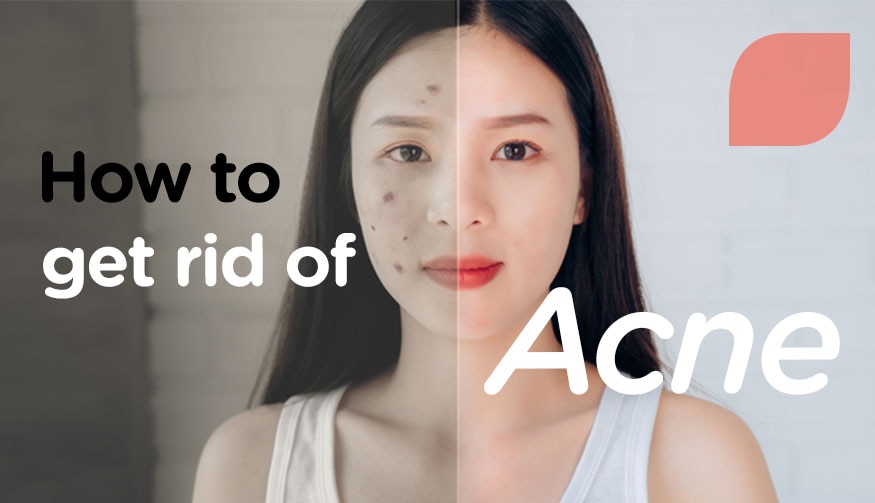 How to act get of acne?