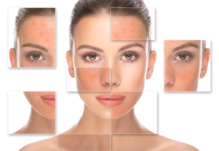 Woman face divided in pieces - showing new skin after acne treatment.