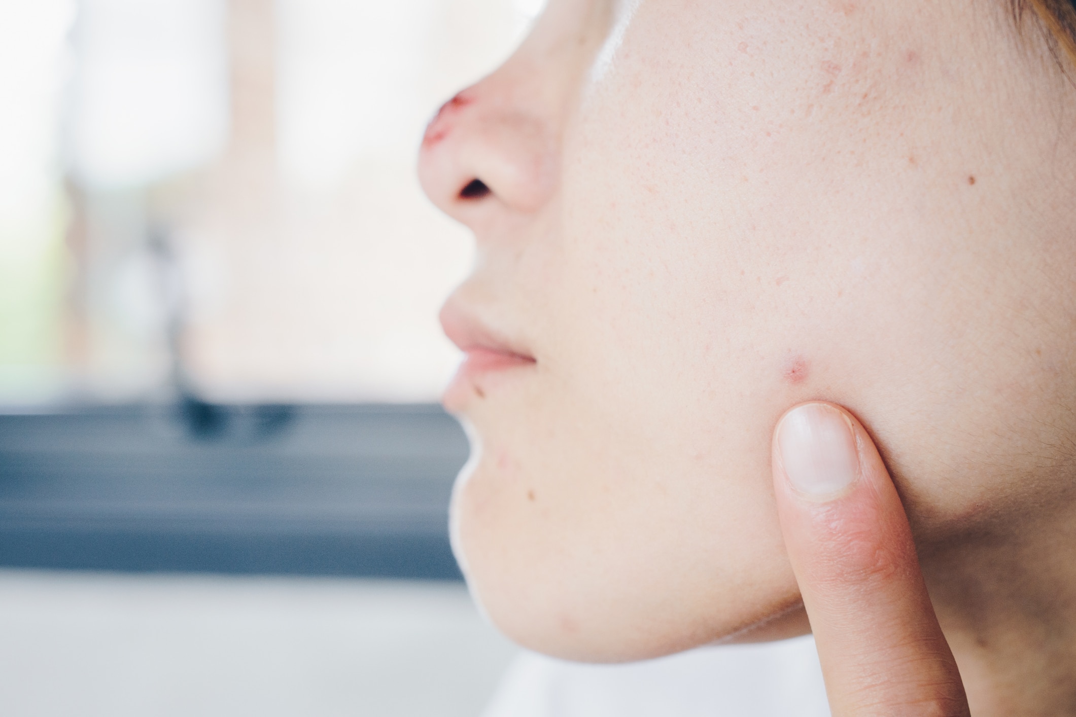 Close up of the face of young lady with acne scar