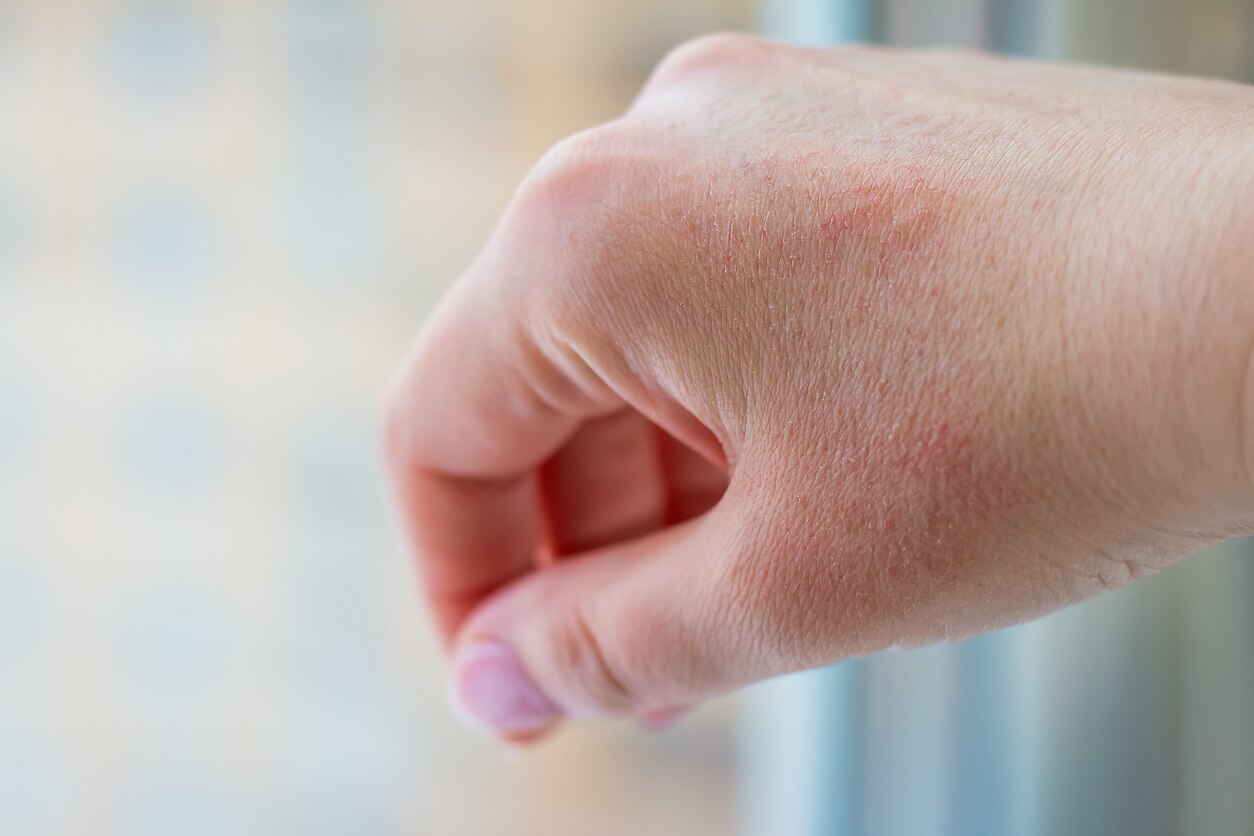 Selective and soft focus of the woman hand with red spots and dry skin. Concept of allergy to wind and frost in winter and cold season. Need to use protective and healing cream, slugging can be use on dry and ichy hand