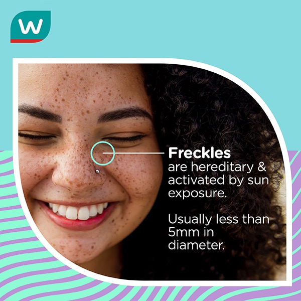 causes and types of freckles