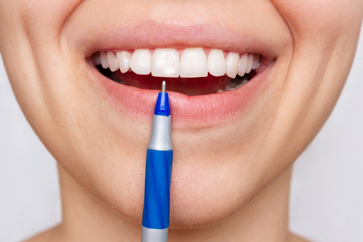 Cropped shot of a young woman pointing to white spot on the tooth enamel with a pen.  Dental fluorosis, side effects of fluoride