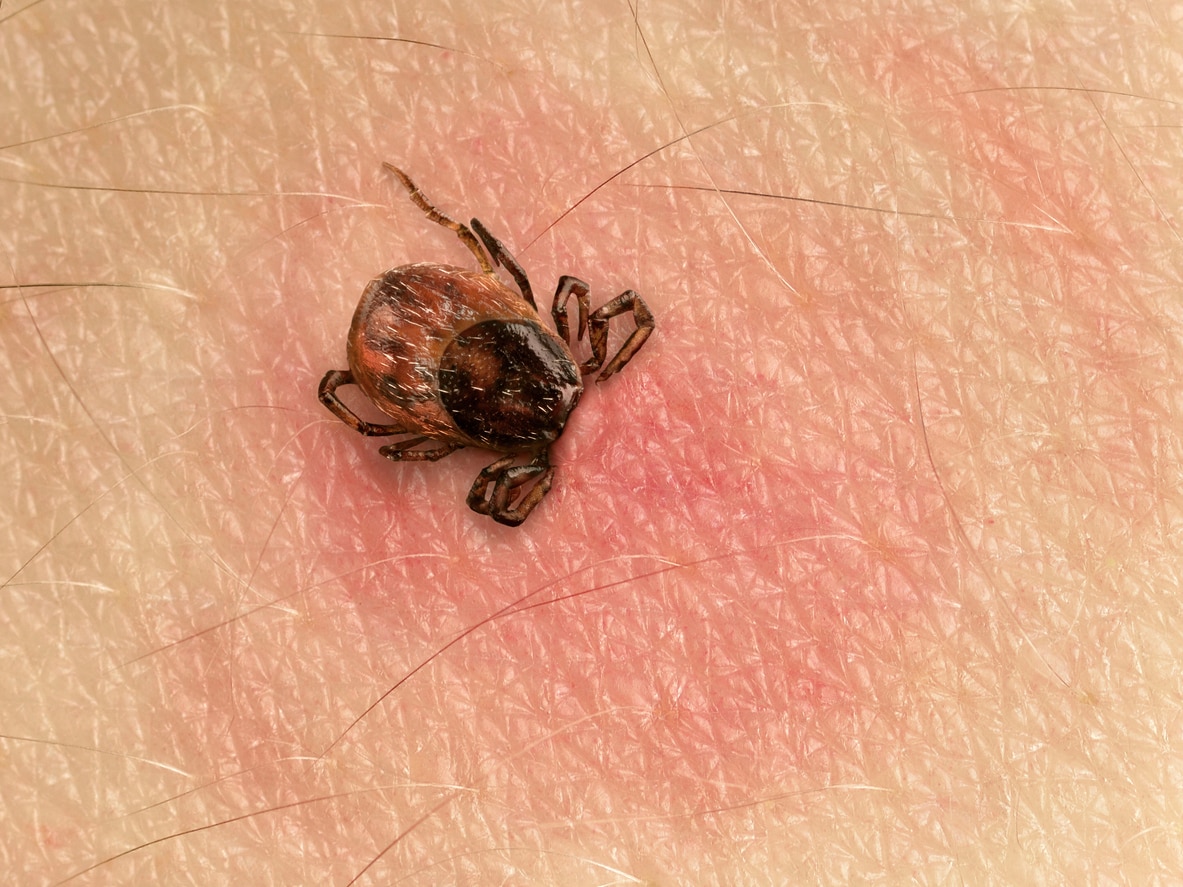 Tick bite, tick with its head sticking in human skin, red blotches indicate an infection